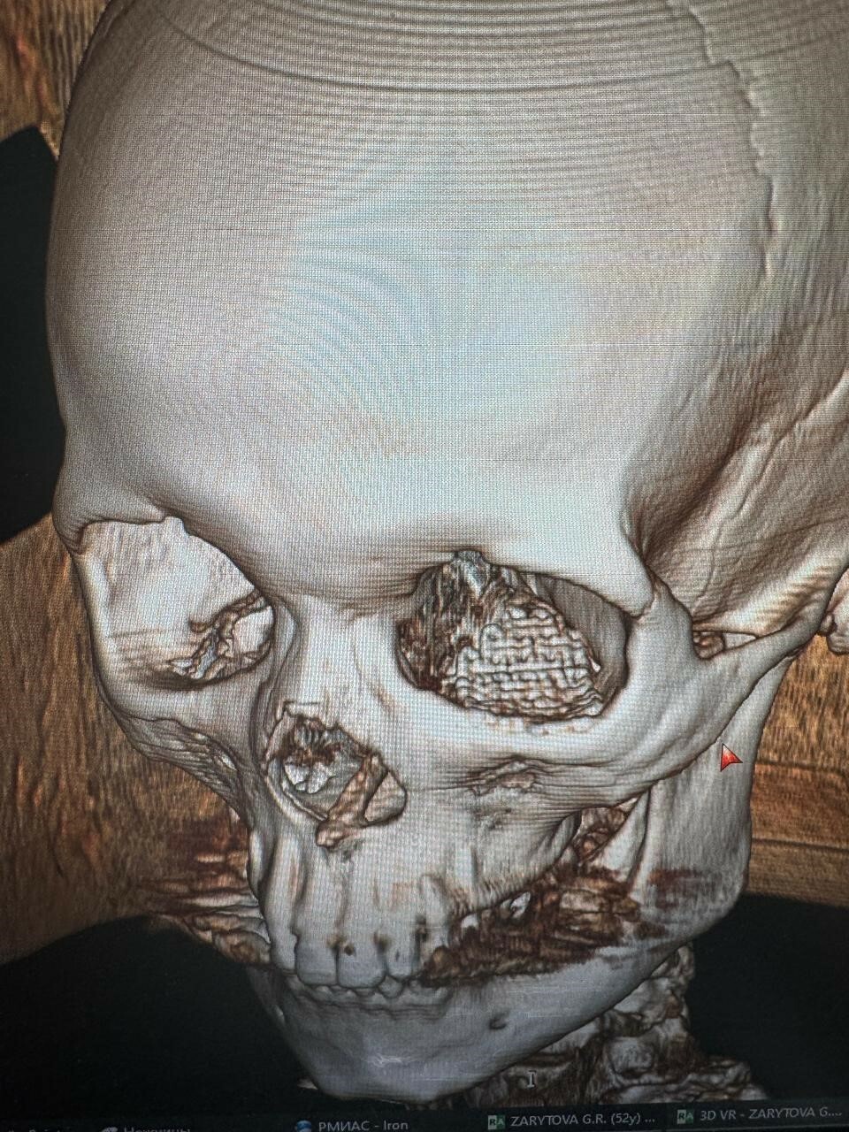 Ученые и врачи из Уфы помогли бойцу СВО восстановиться после боевой травмы